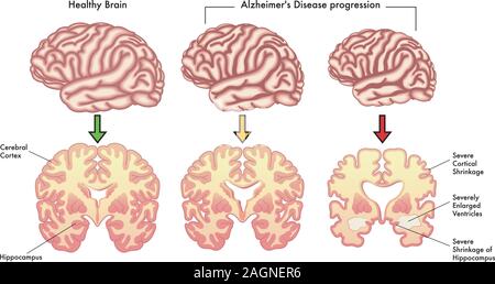 Medical illustration of the symptoms of Alzheimer's disease progression. Stock Vector