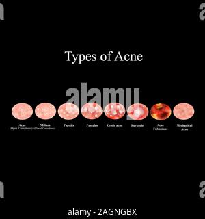 Types Of Acne Skin Inflammation. Pimples, Boils, Whitehead, Closed ...