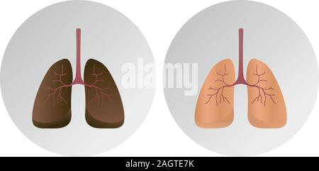 Normal lung and lung cancer Stock Vector Image & Art - Alamy