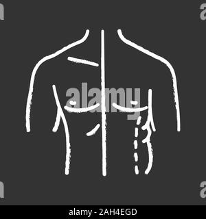 Male coolsculpting chalk icon. Flanks correction. Male liposuction and body contouring before and after. Plastic surgery. Isolated vector chalkboard i Stock Vector