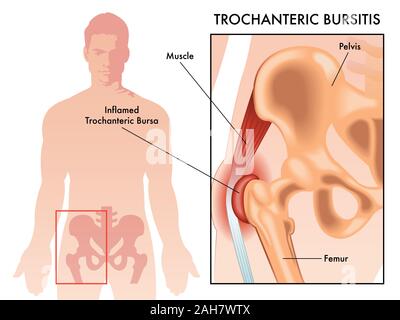 Medical illustration showing trochanteric bursa or trochanteric bursitis in hip of male human diagram. Stock Photo
