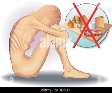 Symbolic medical illustration of the eating disorder called anorexia. Stock Vector