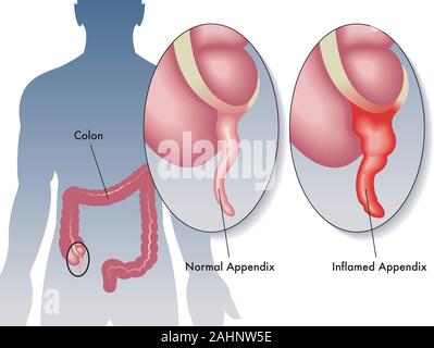 Appendicitis. inflammation of the appendix. large intestine on dark ...