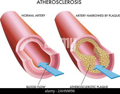 medical Illustration of the effects of atherosclerosis Stock Vector