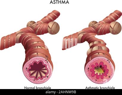 Medical illustration of the effects of the Asthma. Stock Vector