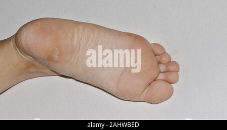 Close-up shot of a plantar wart on the bottom of a foot heel caused by the human papillomavirus, or HPV. Stock Photo