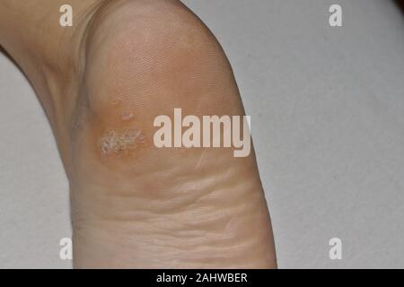 Close-up shot of a plantar wart on the bottom of a foot heel caused by the human papillomavirus, or HPV. Stock Photo