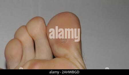 Close-up shot of a plantar wart on the bottom of the big toe caused by the human papillomavirus, or HPV. Stock Photo