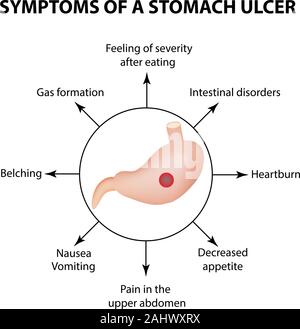 Symptoms of a stomach ulcer. Infographics. Vector illustration on isolated background Stock Vector