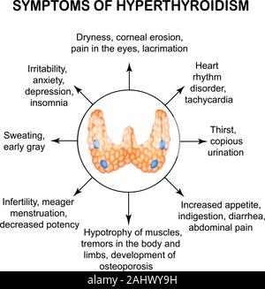 Symptoms of hyperthyroidism. Thyroid. Infographics. Vector illustration on isolated background. Stock Vector