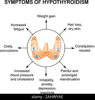 Symptoms of hypothyroidism. Thyroid. Infographics. Vector illustration on isolated background. Stock Vector