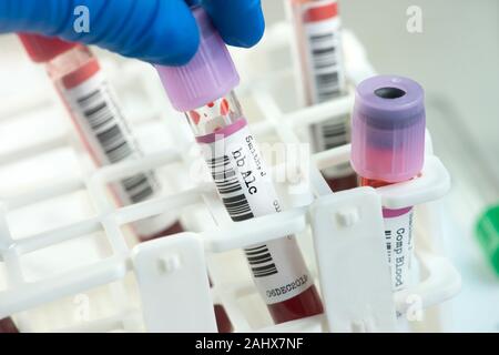 Hb A1c blood test tube chosen from rack by lab technician. The hemoglobin A1c test can asses glucose control and insulin regiment effectiveness in dia Stock Photo