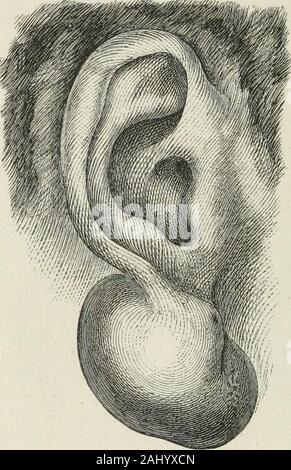 Archives of ophthalmology and otology . Turnbull, are not inclined to take them as a consequence of theinjury alone, but let a peculiar condition of the system, especiallyscrofulosis, or a galvanic action of the alloyed metals of the ear-ring, play a part in their production. I think that these tumorsexemplify in a typical manner the fact that chronic inflammation,by organization ol the exudation, lead to the formation of tumors,especially of connective-tissue tumors. Another well-known ex-ample of the same fact is the development of chalazia and largerfibrous tumors in the eyelids. In the lob Stock Photo