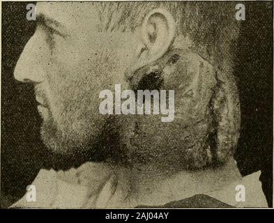 Modern surgery, general and operative . Fig. i8q.—Sarcoma of antrum Treatment.—A lymphatic nevus requires excision. In macroglossia thebulk of the mass should be removed by a V-shaped cut, the mucous mem-brane being sutured so as to cover the stump. In conditions due to the filaria,anilin-blue has been given internally.. Fig. 190.—Small round-celled fungating sarcoma of neck. Malignant Connective=tissue Tumors, or Sarcomata.—The sarco-mata are composed of embryonic tissue-ceUs, the intercellular substance beingvery scanty, and they resemble a process of chronic inflammation. Theydevelop from c Stock Photo
