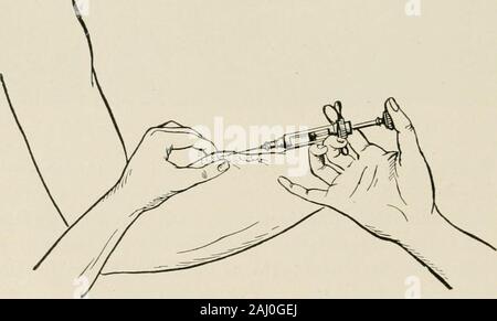 Local and regional anesthesia; with chapters on spinal, epidural, paravertebral, and parasacral analgesia, and other applications of local and regional anesthesia to the surgery of the eye, ear, nose and throat, and to dental practice . Fig. 8. Fig. 9Figs. 8, 9.—Intradermal infiltration (after Reclus) (Braun). Stock Photo