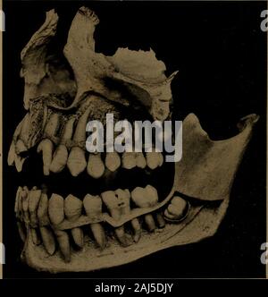 A text-book of dental histology and embryology, including laboratory directions . Dentition in the thirteenth year. Note the relation of the bicuspid crown to theroots of the lower temporary molar. A deviation from the normal relation of these teeth willentirely change the direction of the forces, and will be mani-fested by a modification in the development in the bone.In the skull at this period the bicuspids are seen lying belowthe temporary molars, and the second molar developing at26 402 THE TEETH AND DEVELOPMENT OF THE FACE the distal of the first. Their growth is transmitted throughthe t Stock Photo
