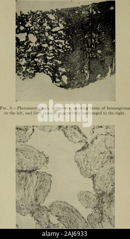 Transactions of the Southern Surgical and Gynecological Association . Fig. 2.—Photograph of tumor cut and laid open.. Fig. 4.—Photomicrograph, high power, showing structure of fibroussepta and endothelial lining of large cavernous spaces. Stock Photo