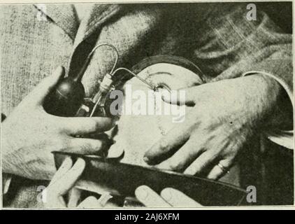 The commoner diseases of the eye : how to detect and how to treat them . Irrigating the Upper Cul-de-sac. stream of water which strikes the eye should notcome with too much force and that the end ofthe pipette should not touch the cornea, or an-terior portion of the eyeball, lest these parts beinjured. Thorough flushing of the parts ratherthan the employment of force is the object ofirrigation. The nozzle of the irrigating apparatus 468 COMMONER DISEASES OF THE EYE should, consequently, not be directed at the globe;it ought to be held nearly parallel with the lidedges. In irrigating the upper Stock Photo