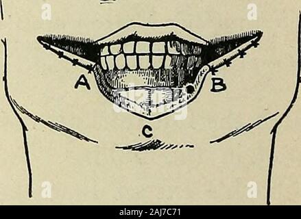 Plastic surgery; its principles and practice . Fig. 591.—Operation for the reconstruction of the lower lip with lateral flaps (Berger).—I and 2. Incisions continuous with the commissures are made on each ^side and themucous membrane and skin are sutured together. Stock Photo