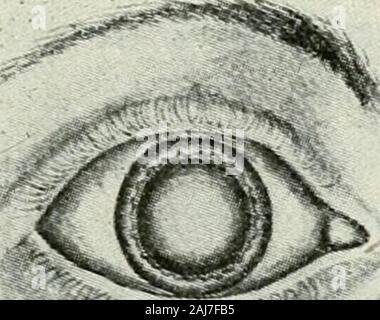 The commoner diseases of the eye : how to detect and how to treat them . Nuclear Cataract. Coitical Cataract. Cataract or opacity of the crystalline lens is the result of structural changes in the cells andfibres of which it is composed. Sometimes thesealterations of structure are irregularly dis-. ^ ?e^ Stock Photo