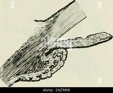 The commoner diseases of the eye : how to detect and how to treat them . or hypermetropic) eyes havesmall corneas and less space in the neighborhoodof the angle of the anterior chamber and so arepredisposed to attacks of glaucoma. In otherwords, the retention of the intraocular fluid isresponsible for all forms of glaucoma. In thechronic variety the changes that take place areso gradual that complete closure of the angleof the anterior chamber does not occur. Thoughdrainage through the lymph channels is moreor less obstructed, they are not completely closed.As the disease advances and the obst Stock Photo