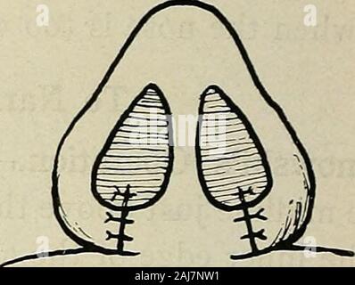 Plastic surgery; its principles and practice . Fig. 541.—Operation for narrowing the base of the nose (Kolle).—i. The dark andalso the dotted lines indicate the incisions made for removal of tissue. 2. The edgesapproximated. g&gt; &lt;^ Stock Photo