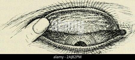 The commoner diseases of the eye : how to detect and how to treat them . Typical Granular Lid and Beginning Scars, with Pannus. and intersected by a number of whitish lines showing that the conjunctiva has been replaced by connective tissue. As the disease still further advances othercomplications arise. The ocular conjunctiva be-comes congested and a vascular condition of thecornea occurs, bringing about a condition calledpannus, which is nothing more or less than theextension of the trachoma to the cornea. Theupper portion of the cornea is generallv the first COMMONER DISEASES OF THE CONJUNC Stock Photo