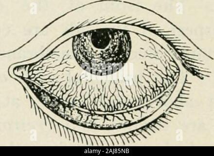 The commoner diseases of the eye : how to detect and how to treat them . e under-lying sclera. The whole membrane is coveredwith pavement epithelium which is continuedover the cornea and extends into the canaliculito the lachrymal sac. It is thrown into a moreor less plainly marked reduplication at the innercanthus, where it represents the third eyelid ornictitating membrane of the lower animals. It is well to remember that the conjunctiva 13* COMMONER DISEASES OF THE EYE is supplied by two distinct sets of bloodvessels,anterior and posterior, because of their value indiagnosticating deep lesi Stock Photo