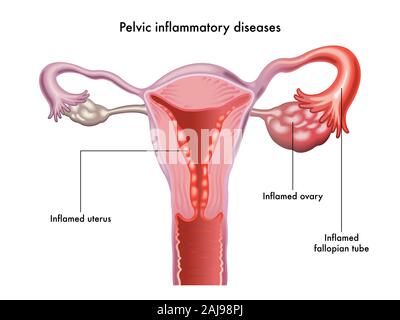 Pelvic inflammatory diseases illustrated in anatomical form on white. Stock Photo