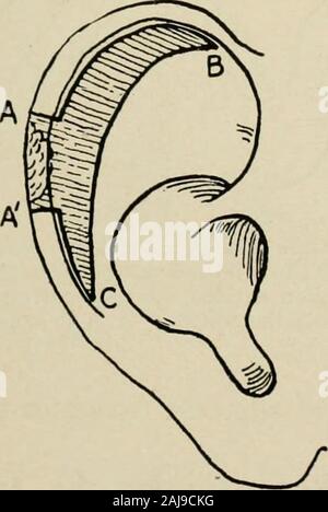 Plastic surgery; its principles and practice . Fig. 411.—Gersunys operation for closing a defect in the helix (J. S. Stone).—Whenthe defect on the helix is low down a crescentic piece of tissue should be removed from themost prominent and curving portion of the ear, and not in the area adjacent to the defect.The edges are sutured.. Stock Photo