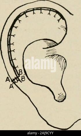 Plastic surgery; its principles and practice . Fig. 411.—Gersunys operation for closing a defect in the helix (J. S. Stone).—Whenthe defect on the helix is low down a crescentic piece of tissue should be removed from themost prominent and curving portion of the ear, and not in the area adjacent to the defect.The edges are sutured. Stock Photo