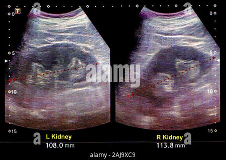 Kidneus ultrasound Stock Photo