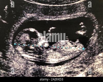 Ultrasound of a 3 month old fetus Stock Photo - Alamy