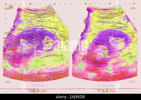 Kidneus ultrasound Stock Photo