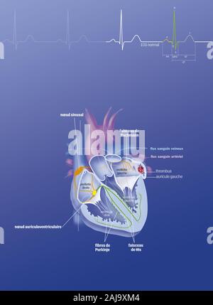 Atrial fibrillation Stock Photo