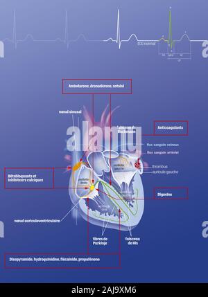 Atrial fibrillation and treatments Stock Photo