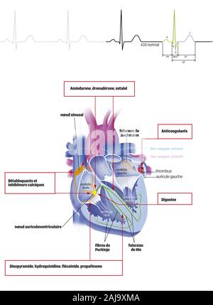 Atrial fibrillation and treatments Stock Photo