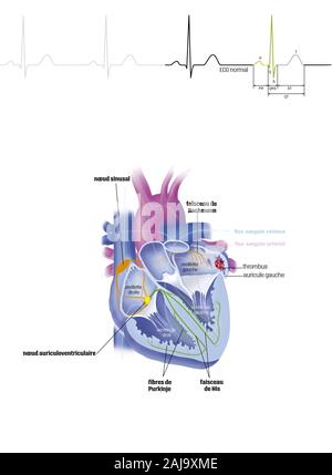 Atrial fibrillation Stock Photo