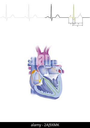 Atrial fibrillation Stock Photo