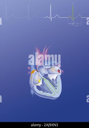 Atrial fibrillation Stock Photo