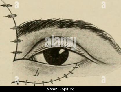 Plastic surgery; its principles and practice . Fig. 356.—The flap b is taken from the nose and forehead for restoration of the lower lid.The greater part of the defect being on the inner side. Stock Photo