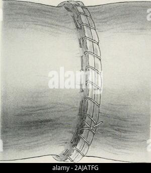 Annals of surgery . complete) cut in theartery. Method of Suturing a ...