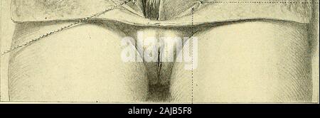 Operative gynecology : . iL-.Pouparts si lig- ??-•Ext. ring Round lig.Fig. 17.—Abdominal Muscles, the Skin and Fat Reflected Back Showing the External Oblique,the Semilunar Line, and the Fascia Covering the Rectus on the Left Side. On the RightSide the External Oblique is Reflected Upward Showing the Internal Oblique. ThePyramidalis is Seen Lying within the Right Rectus Sheath. down to the semilunar fold of Douglas, which lies at a point about 3 cm.below the umbilicus. Below this point the thin tissue allows the convolu-tions of the intestines to be seen through the fascia and peritoneum. The Stock Photo