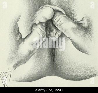 Annals of surgery . Fig. 2.—The dilatation of the sphincter ani. Stock Photo