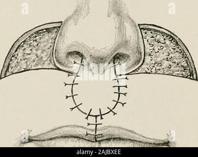 Surgical treatment; a practical treatise on the therapy of surgical diseases for the use of practitioners and students of surgery . Fig. 968. — Operation forDouble Harelip with Cheek Flaps.Lines of Incision. First Stage.. Stock Photo