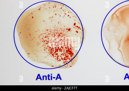 Abo blood type testing hi-res stock photography and images - Alamy