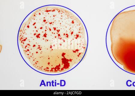 Abo blood type testing hi-res stock photography and images - Alamy