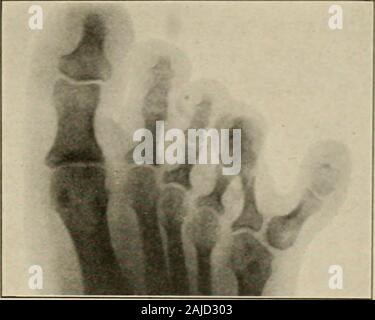 Plastic surgery; its principles and practice . Fig. 183 .—Supernumerarythumb.—Amputation with propertrimming of the projecting articu-lation was done. Fig. 184.—Polydactylism. (X-ray Xo.35961).—Double little toe. Stock Photo