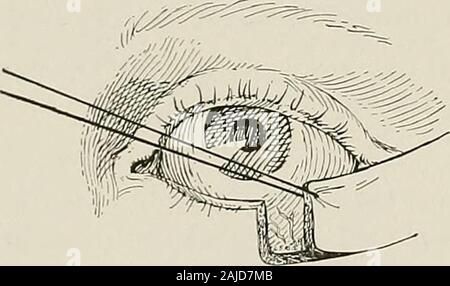 Surgical treatment; a practical treatise on the therapy of surgical diseases for the use of practitioners and students of surgery . Fig. 796.—Blepharoplasty. Second Step. The lid has been resected.. Fig. 797.—Blepharoplasty. Third Step. The flap having skin on either side is liberated and drawn into the defect. Stock Photo
