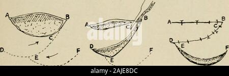 Plastic surgery; its principles and practice . Fig. 35.—Double bilateral flaps with pedicles above and below.. Stock Photo